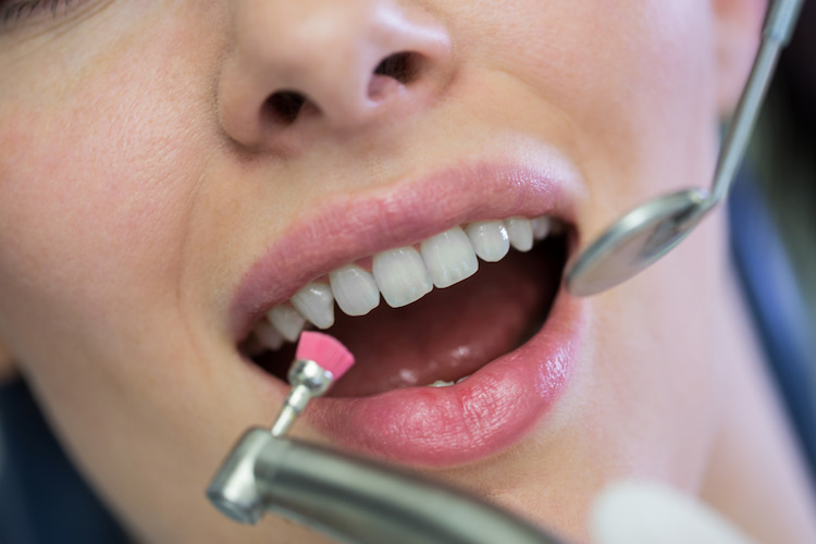 Types of Cosmetic Dentistry Procedures