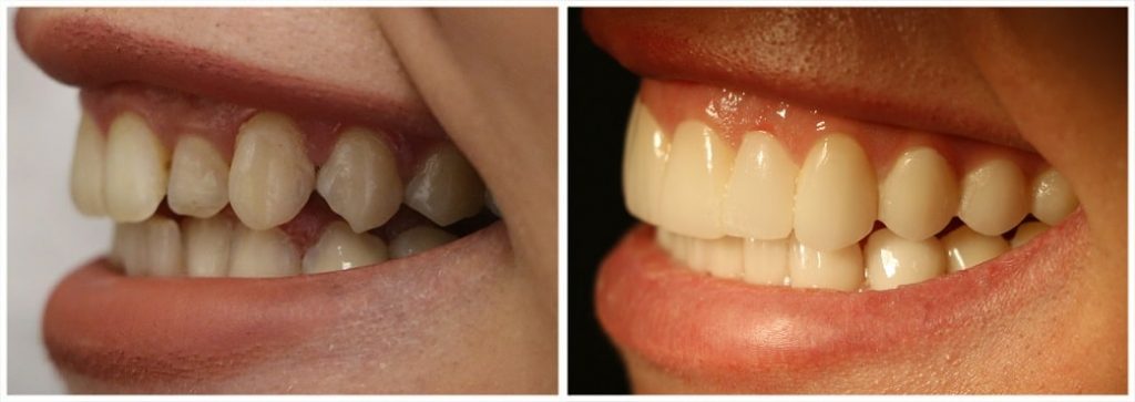 Dry Socket - North Richmond Hill Family& Cosmetic Dentistry