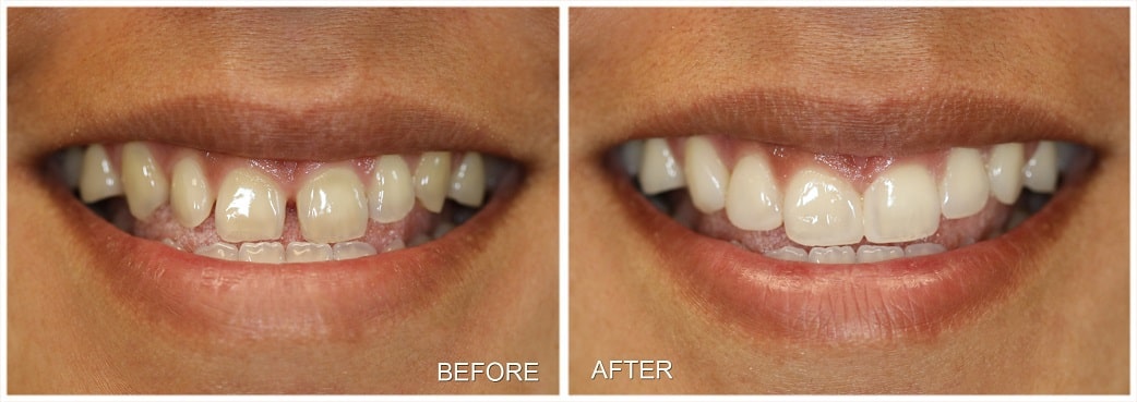 Dental Veneer Toronto | Veneers in one day + Discounts