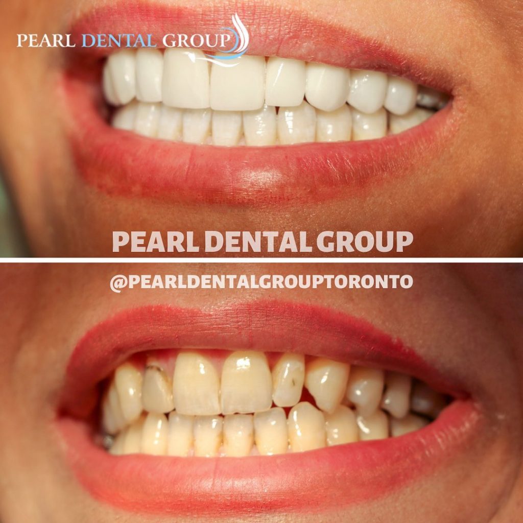 Cosmetic Dentist Toronto | Veneers In One Day | Affordable Prices