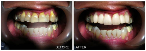 composite veneer for discolored teeth