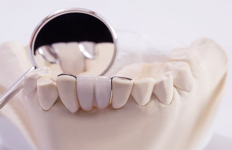 Solutions For A Stunning Smile With Cosmetic Bridge Services