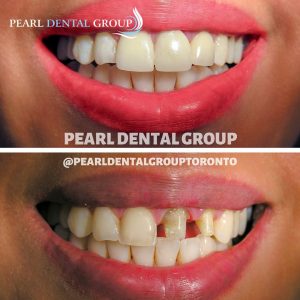 dental bonding and veneer