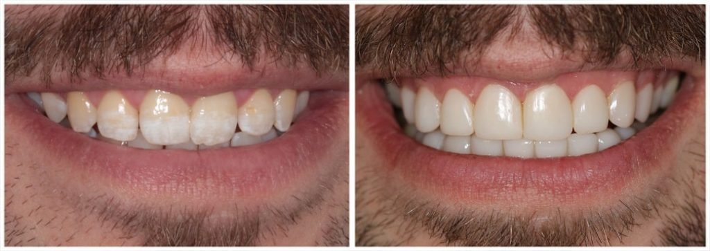 discoloration fixed composite veneers toronto