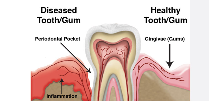 gum disease therapy toronto