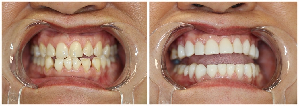 Smile makeover cosmetic dentistry Toronto