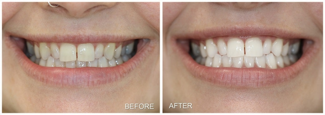 teeth whitening Before After Toronto