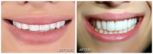Cosmetic Dental veneer Toronto patient