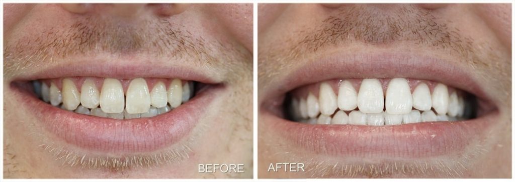teeth whitening Before After