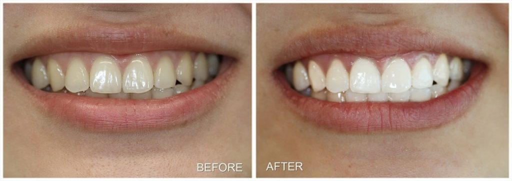 teeth whitening Before After Rebbeca