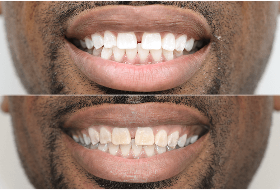 affordable teeth whitening in north york