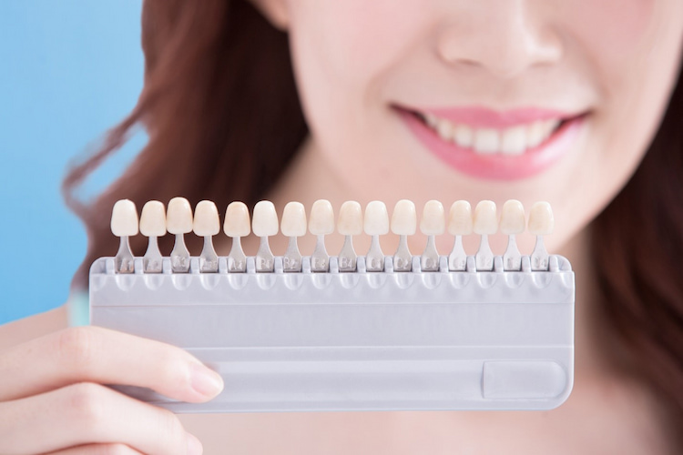 Non-Cosmetic Reasons to Get Veneers