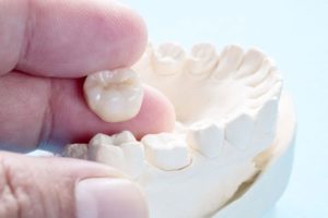 What Are the Alternatives for a Dental Crown?