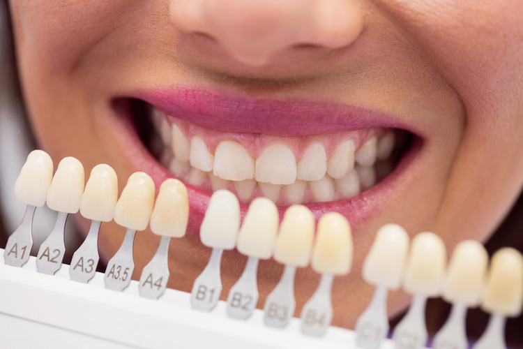 Dental Implants vs. Veneers