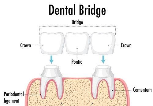 Infographic of human in dental bridge on white background
