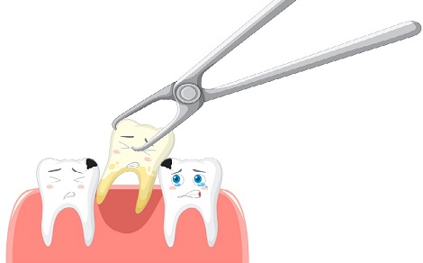 Common Alternatives to Having Your Tooth Extracted