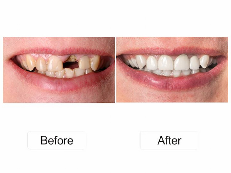 Tooth Replacement Options