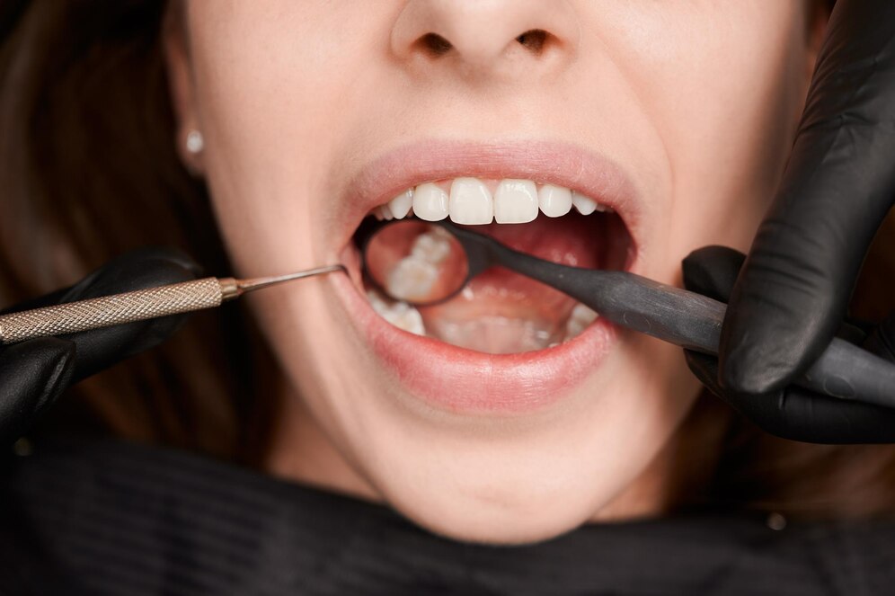 Knocked-out Tooth Reattachment in North York