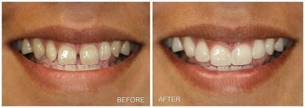 Gap filling with dental veneers