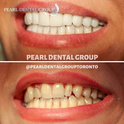 Ceramic Veneers,to give her a perfect smile.