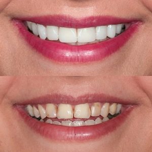 Types of Cosmetic Dentistry Procedures