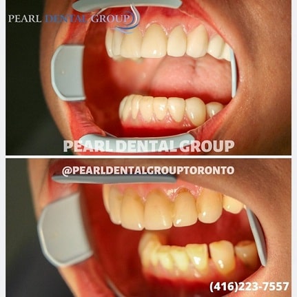 cosmetic dentistry teeth Whitening
