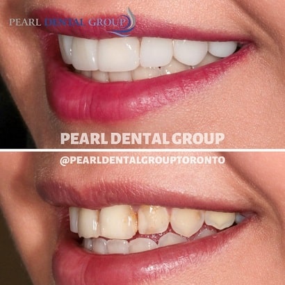 Ceramic Veneers, to fix the shape and discoloration of the teeth.