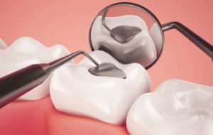 Best Material for Dental Fillings
