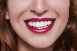 How Long Do Veneers Last?