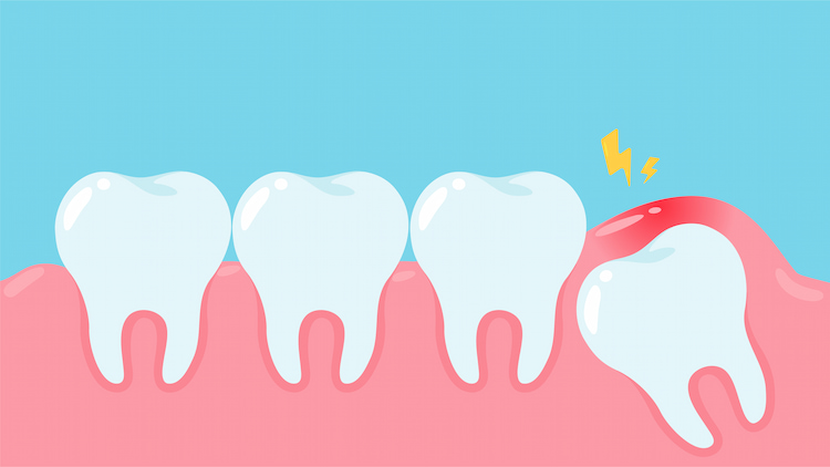 Common Reasons for Tooth Extraction
