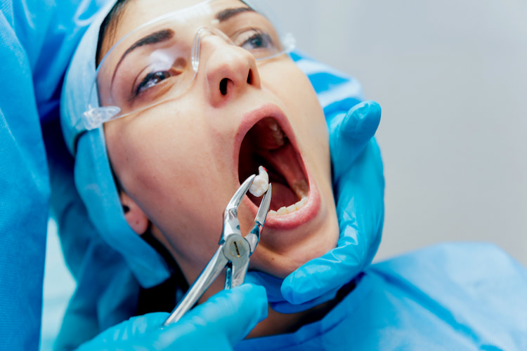 What Is Tooth Extraction?