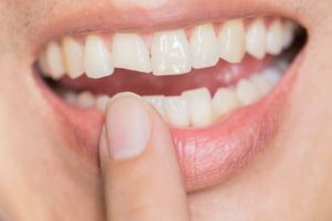 types of tooth fractures