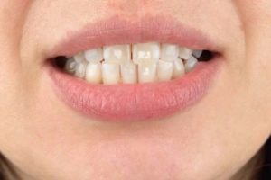 White Spots on Teeth