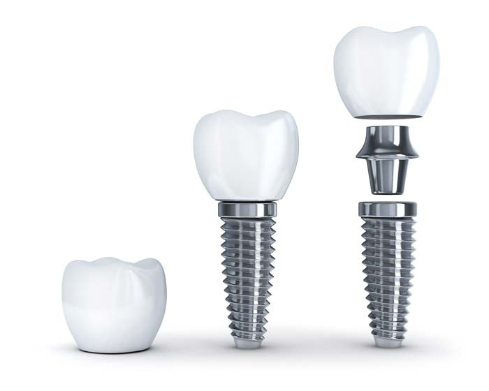 dental implants in Toronto