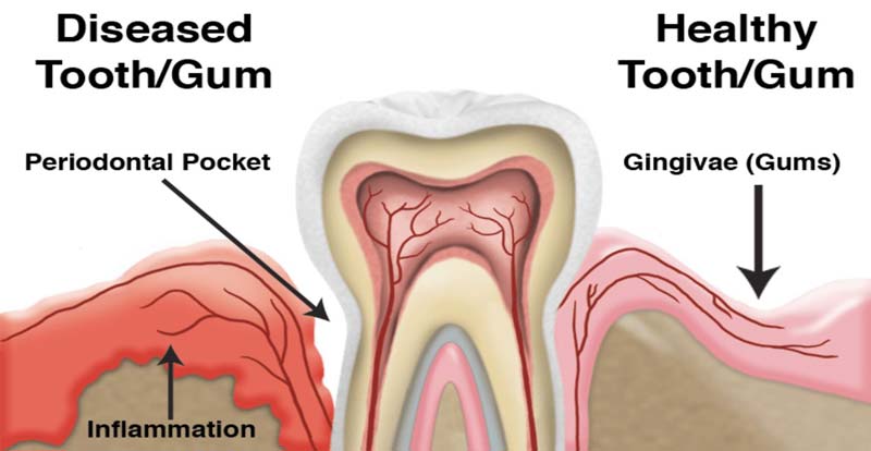 periodontal disease Toronto