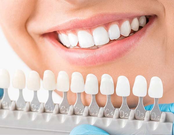 porcelain-veneers