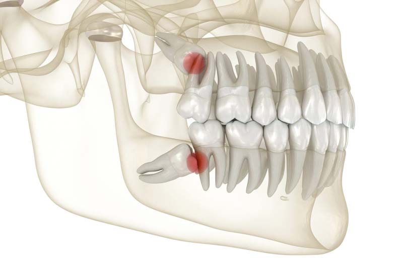 wisdom teeth removal