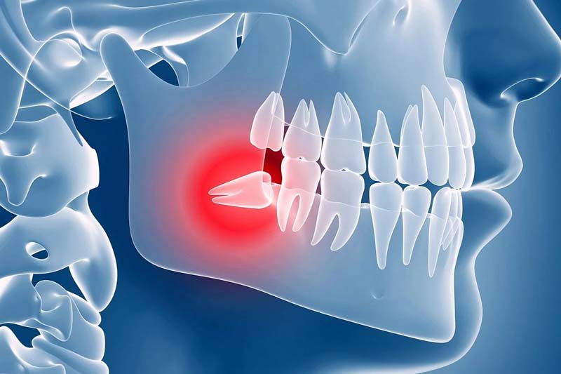 wisdom teeth removal