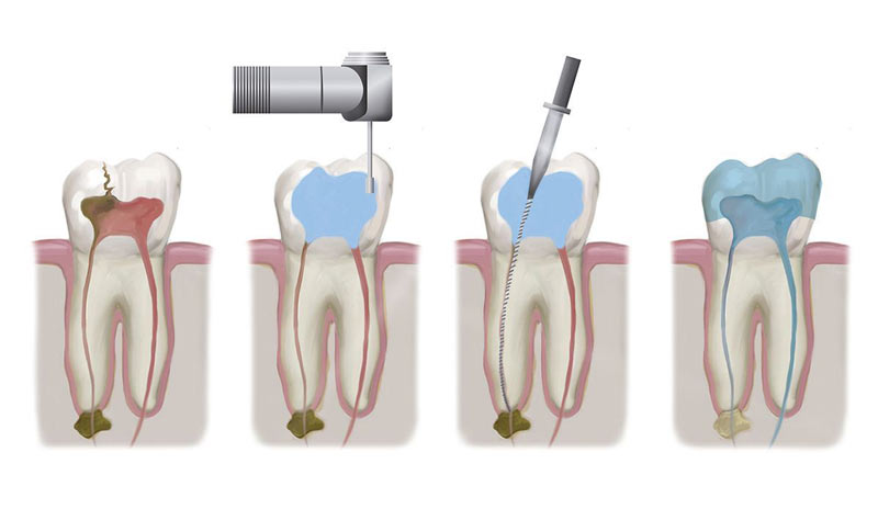 root canal treatment North York