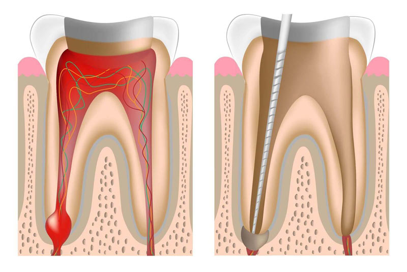 root canal treatment North York