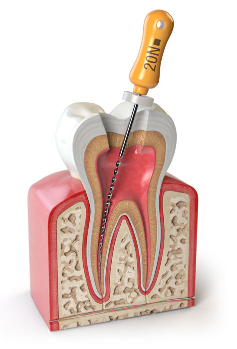 root canal treatment in Toronto