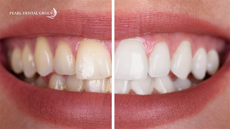 split images of two side of teeth, one before and one after professional teeth whitening
