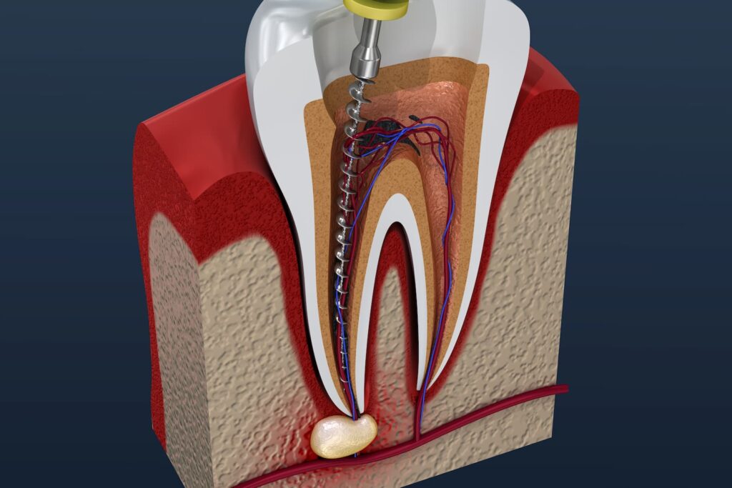 Root Canal Therapy North York