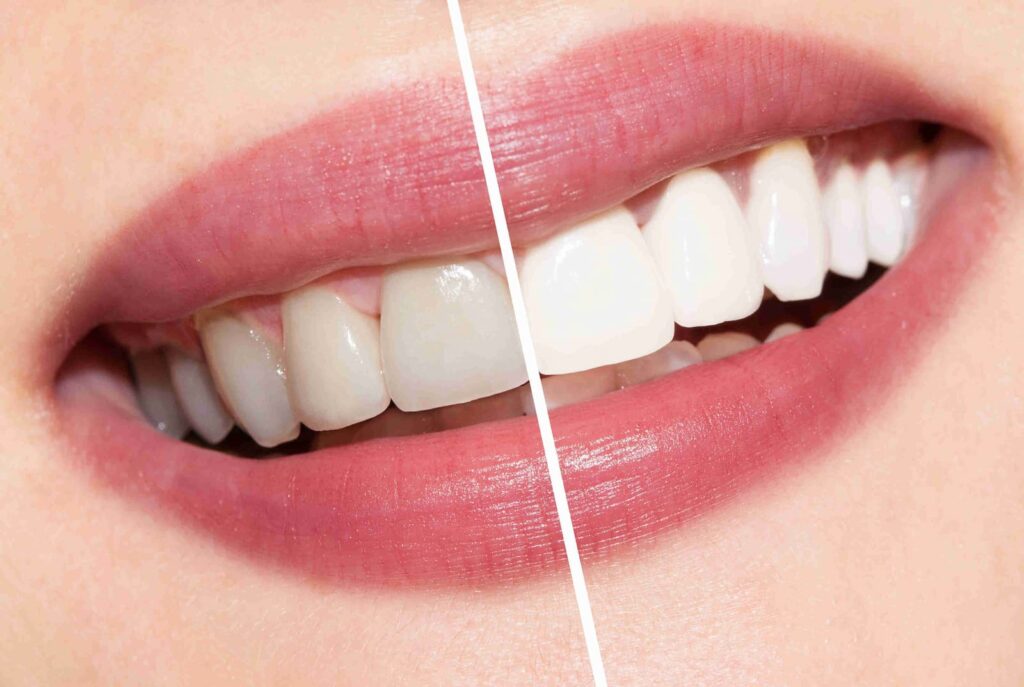 Teeth Whitening Toronto