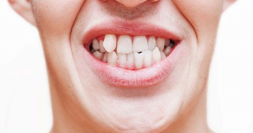 dental veneers for crooked teeth