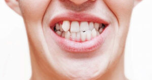 dental veneers for crooked teeth