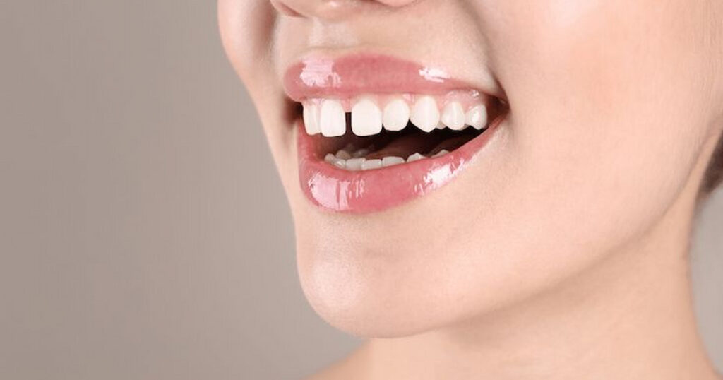 gaps between teeth