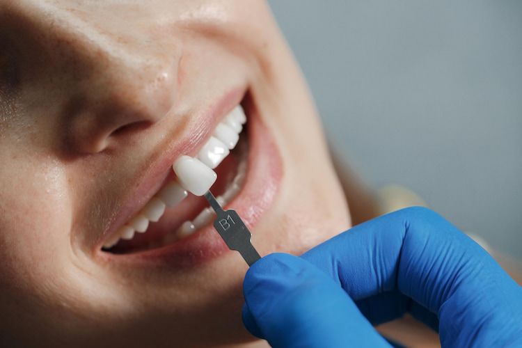 dental veneers for crooked teeth