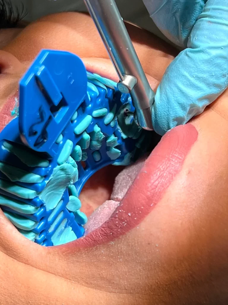 Dental Implants in North York Dr. Aminsalehi, Toronto Dental Implant Specialist