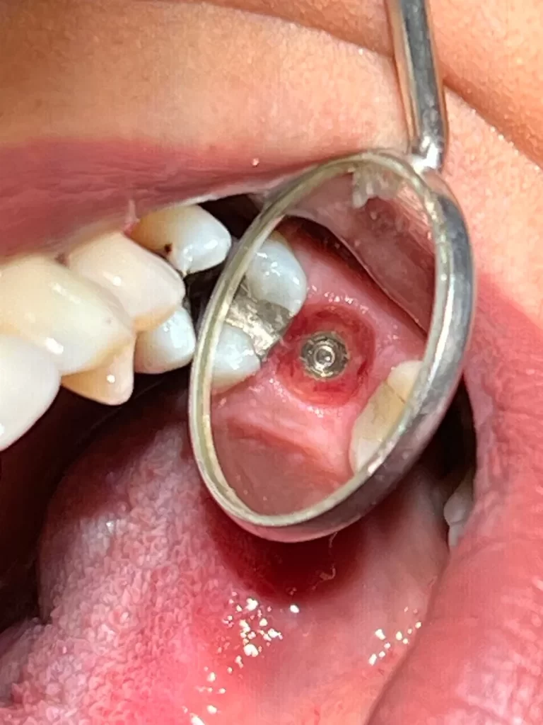 Best Dental Implants in Toronto
